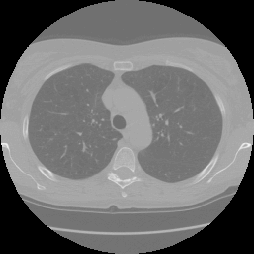 plot of chunk lung_image