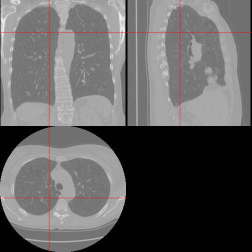 plot of chunk lung_orthographic